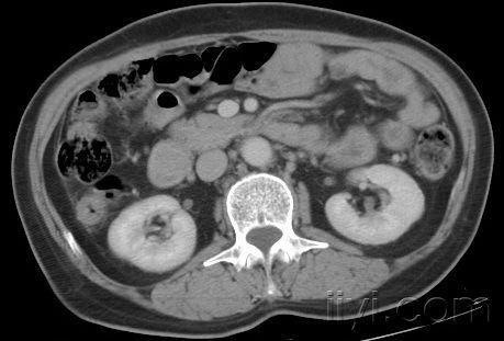 壶腹部实性占位8.jpg