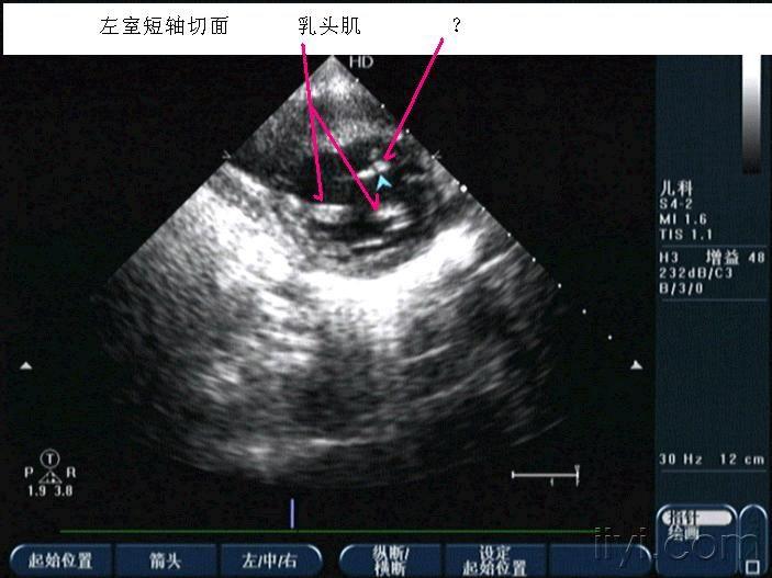 左室假腱索