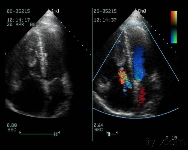 经典的右室及肺动脉血栓 - 超声医学讨论版 - 爱爱医