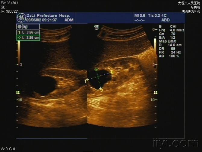 69 超声医学讨论版 69 常见的超声图谱 肾结石 肾囊肿