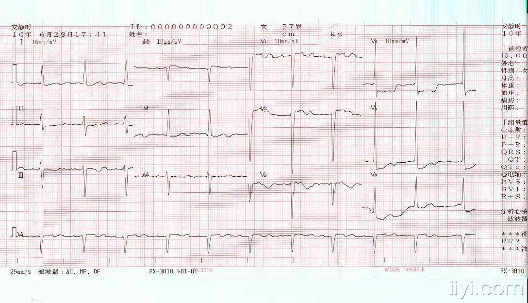 请教心电图完左三度房室分离洋地黄中毒
