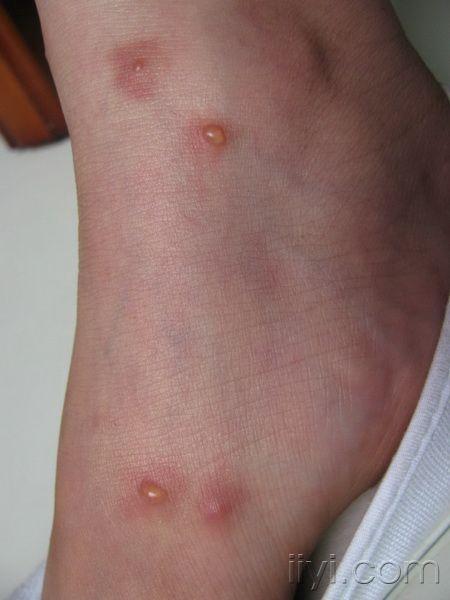 小腿丘疱疹---丘疹性荨麻疹