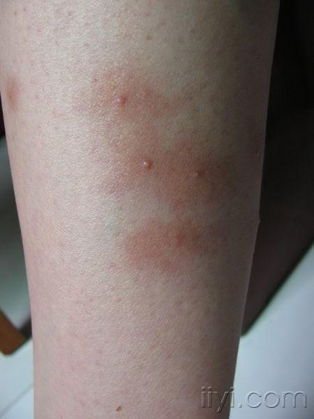 小腿丘疱疹丘疹性荨麻疹