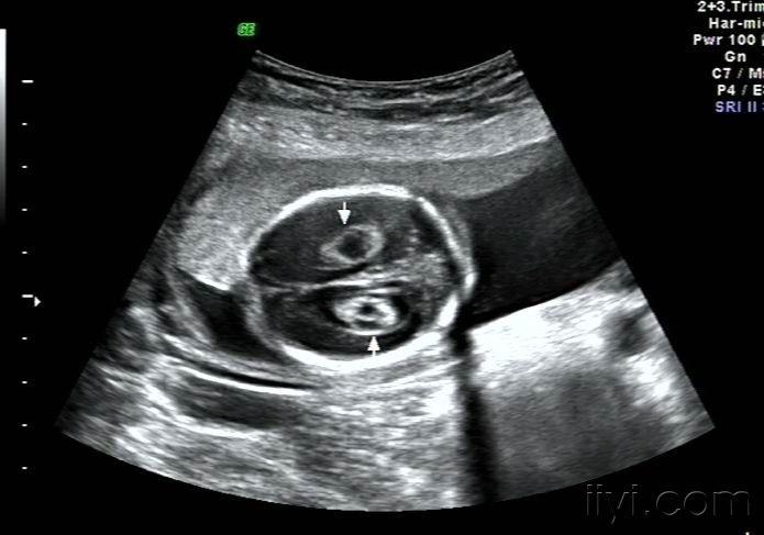 胎儿双侧脉络丛囊肿1.jpg