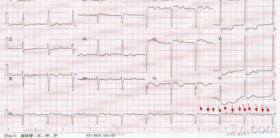 请教心电图----完左?三度?房室分离?洋地黄中毒?
