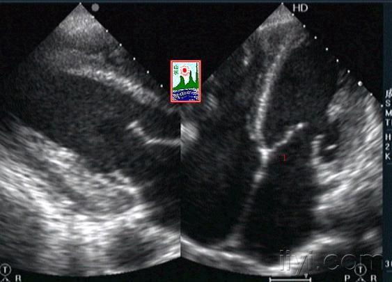 二尖瓣腱索断裂补上一些图片