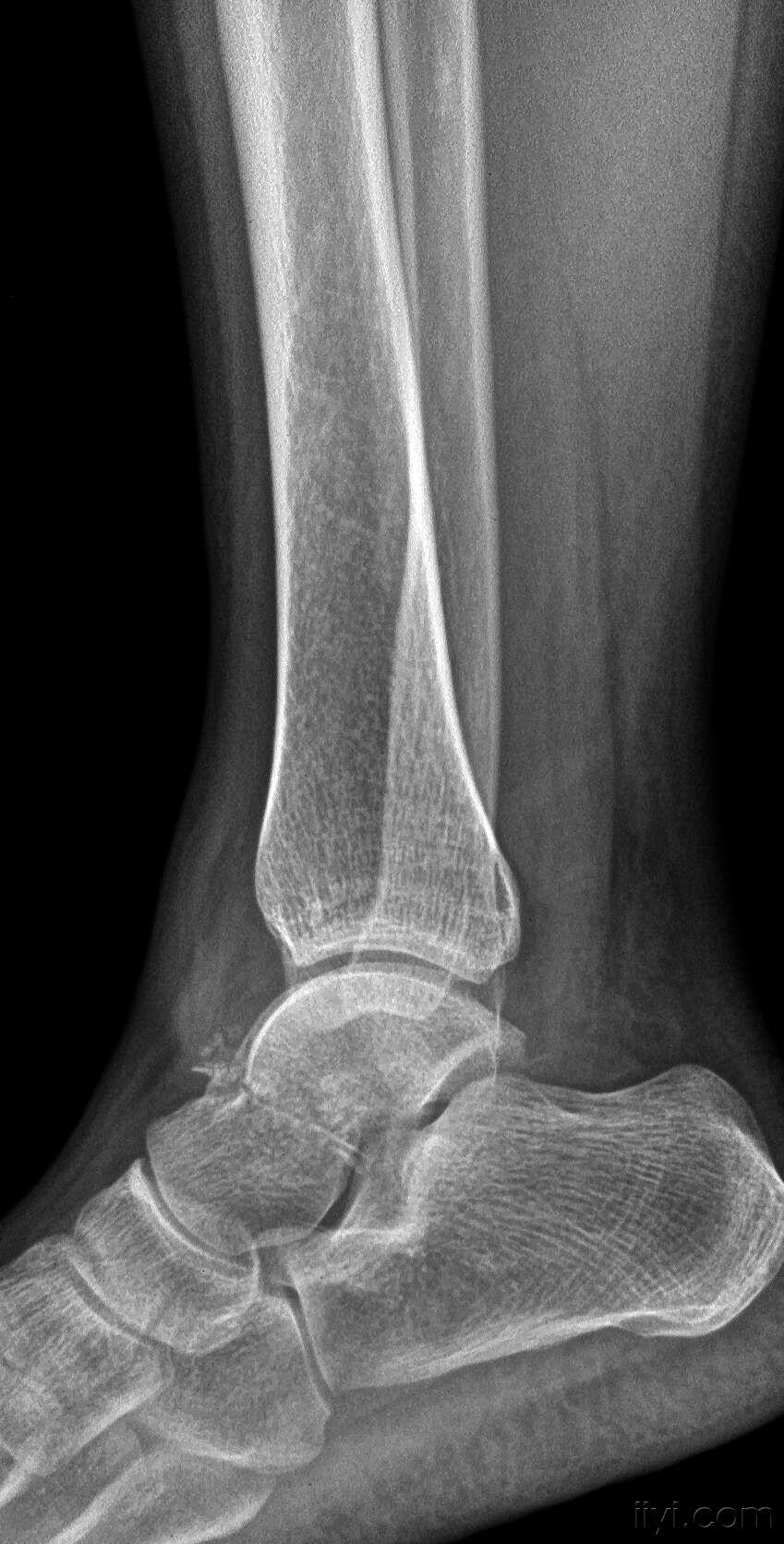 左侧踝关节外伤x光 - 医学影像学讨论版 - 爱爱医医学