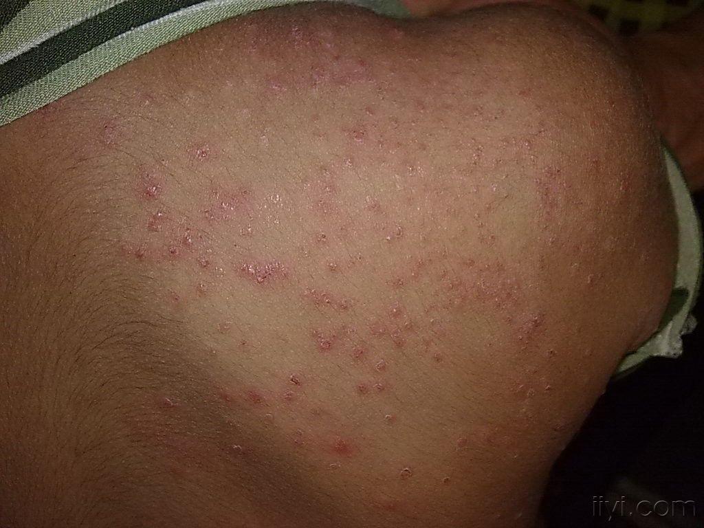 七八月份常见的皮肤病-丘疹型念珠菌病