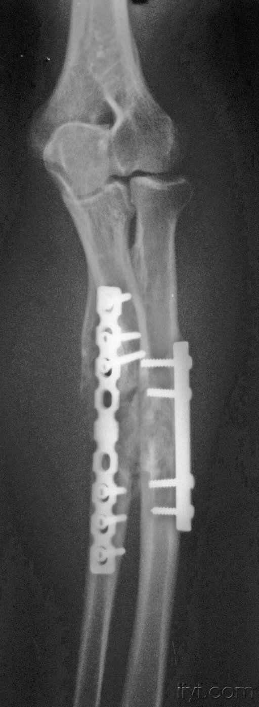 尺桡骨骨折内固定一年.