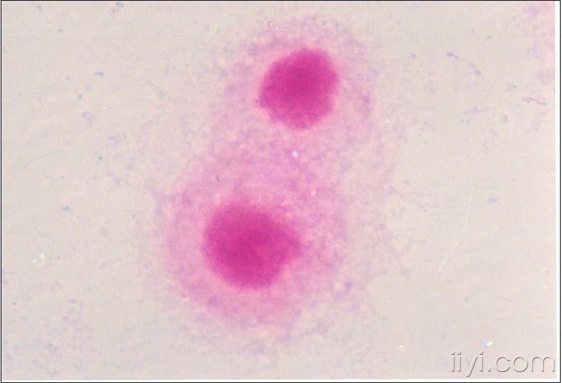 检验医学讨论版 69 微生物图片   l型细菌油煎蛋样菌落   隐球菌