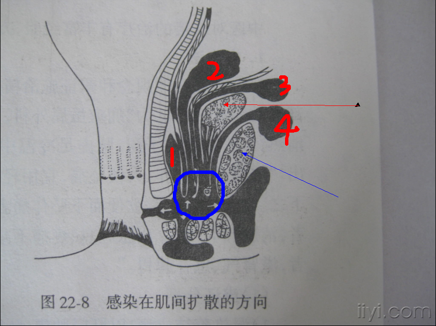 一例肛瘘手术