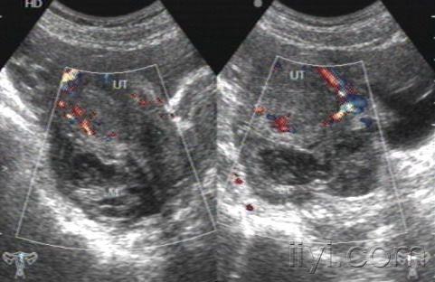 典型病例——黄体破裂一例 - 超声医学讨论版 - 爱爱