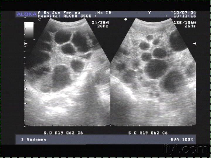 肝包虫病?肝囊性变? - 超声医学讨论版 - 爱爱医医学