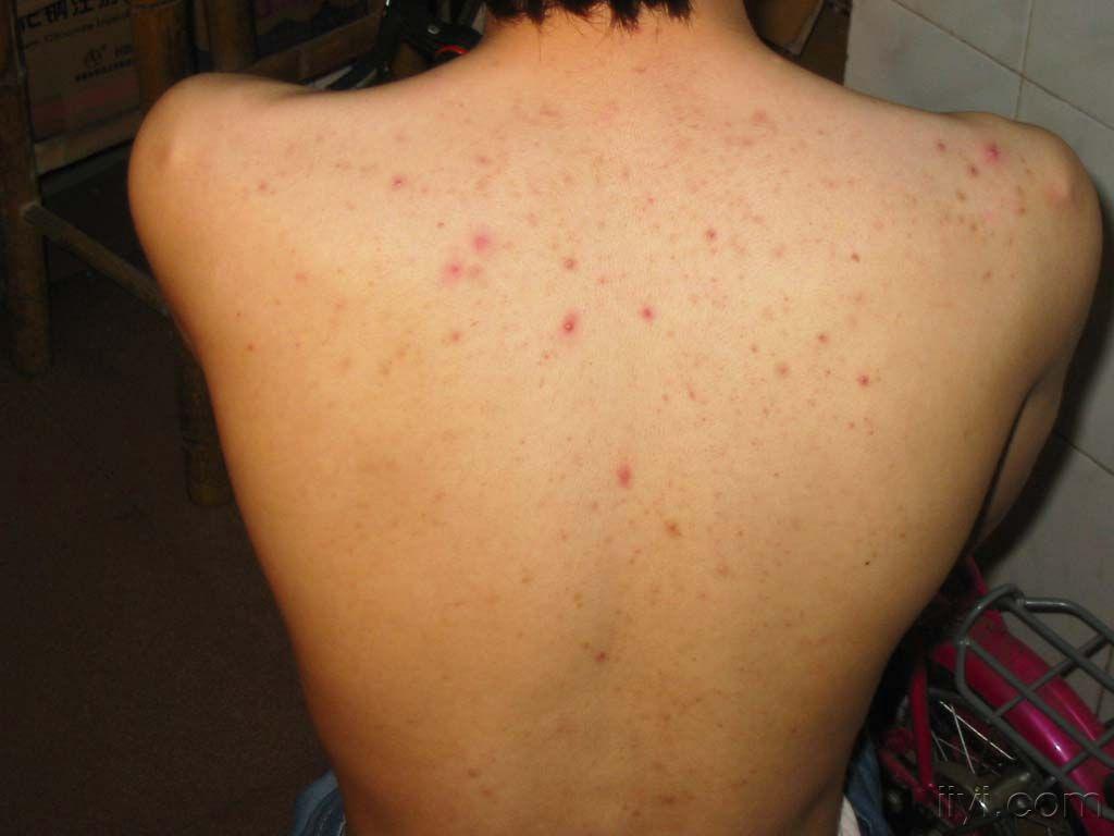 看图识病20100722马拉色菌毛囊炎