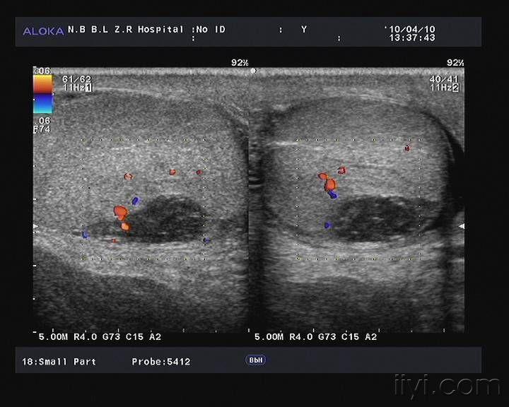 右侧睾丸挫伤伴血肿形成