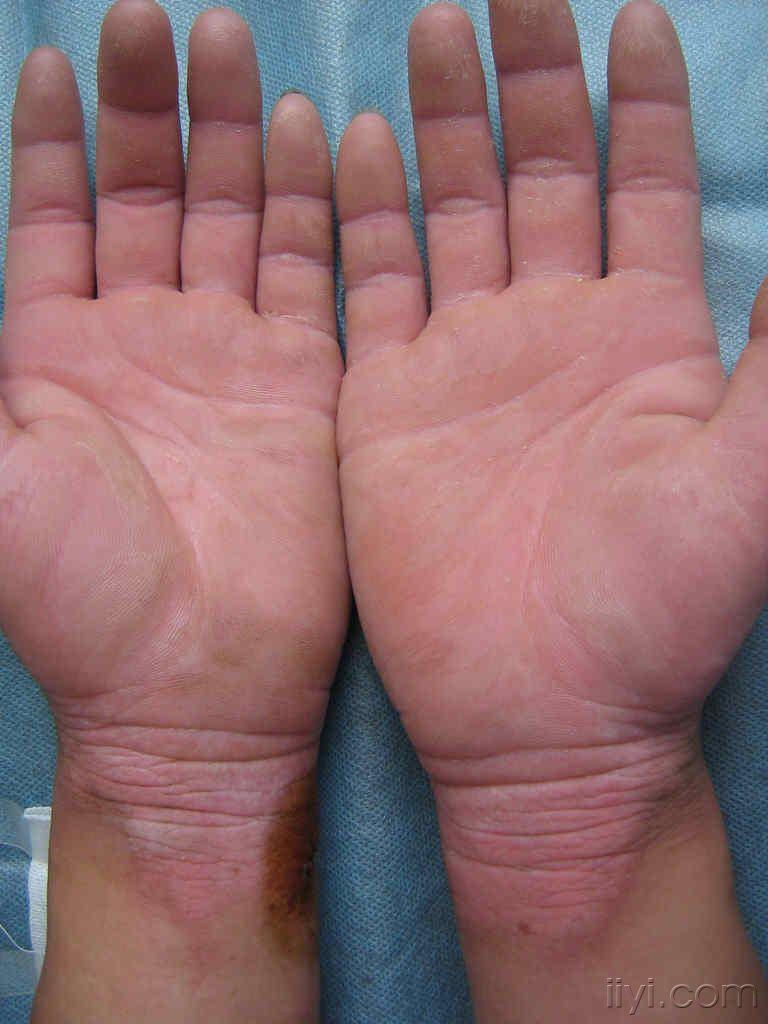 双手掌,手(指)背,腕部皮损----进行性对称性红斑角皮症