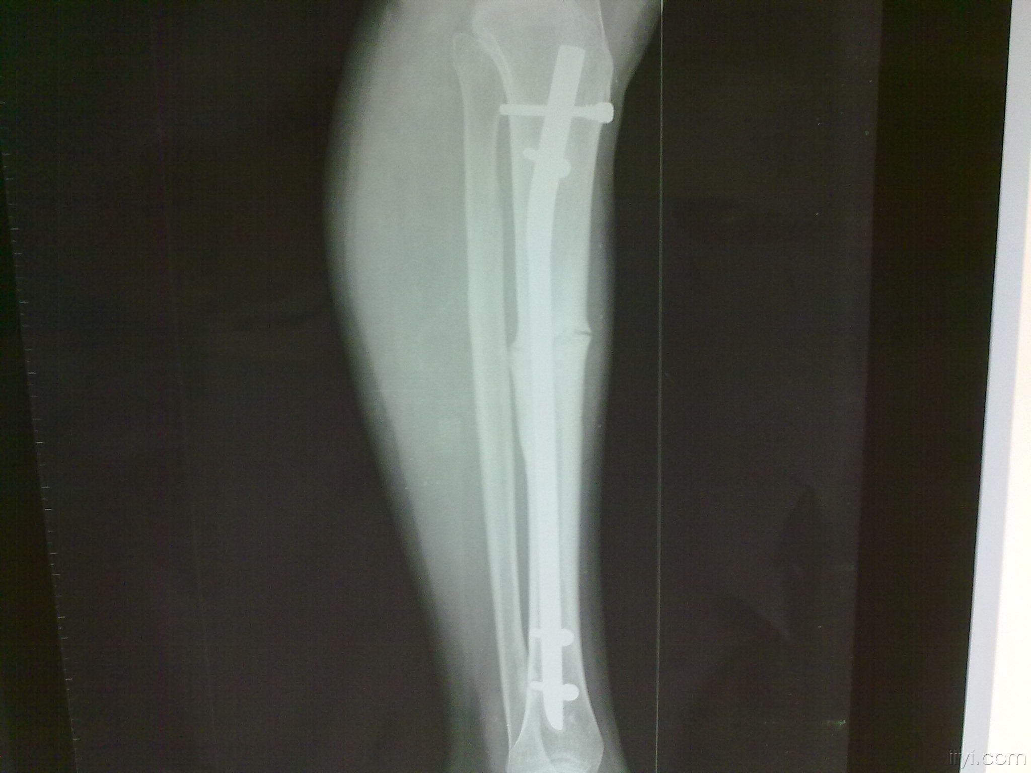 左胫骨骨折髓内钉术后不愈合7年