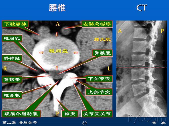 腰椎解剖阅片