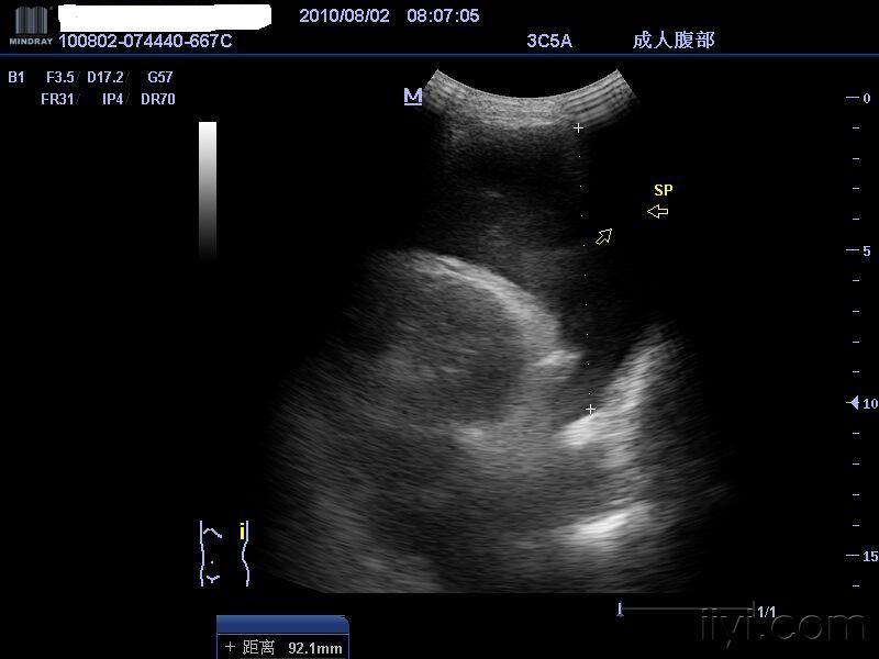 是包膜下脾破裂吗 - 超声医学讨论版 - 爱爱医医学论坛