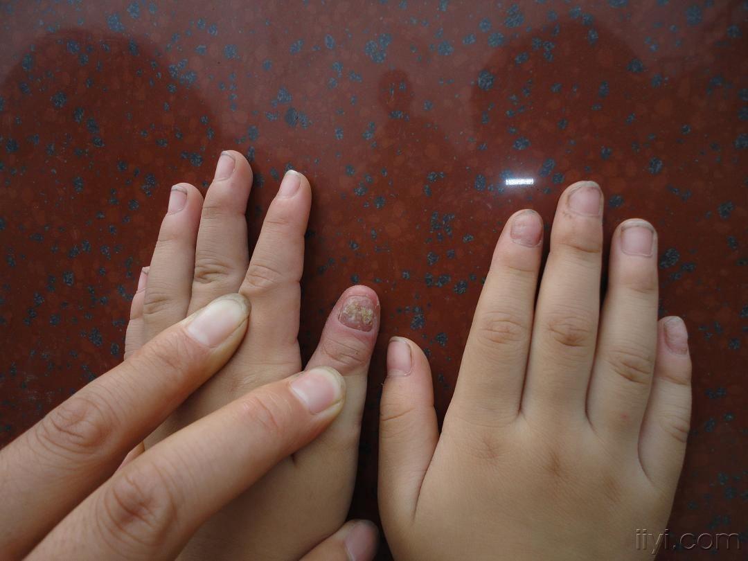 小孩的指甲病反复发作,该如何治疗?