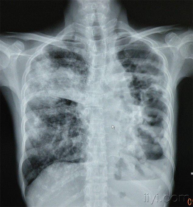 心胸男结核多年左肺怎么解释