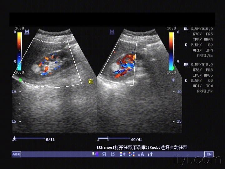 "肾错构瘤"是?不是? - 超声医学讨论版 - 爱爱医医学论坛