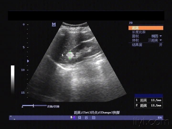 "肾错构瘤"是?不是? - 超声医学讨论版 - 爱爱医医学