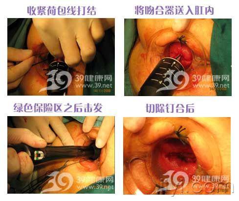 pph痔疮手术中的应用图解希望对大家有帮助