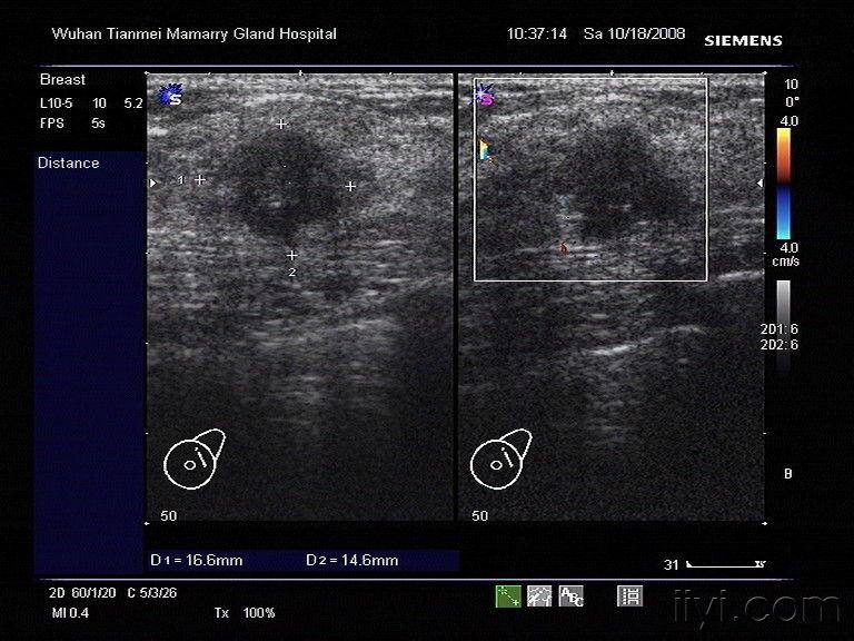 已手术乳腺癌超声图集