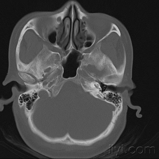 左耳耳鸣2年余乳突ct2mm层厚平扫