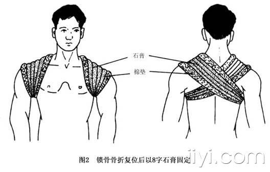 婴儿青枝骨折用什么方法?