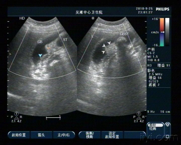 考虑胆囊ca可能 超声医学讨论版 爱爱医医学论坛