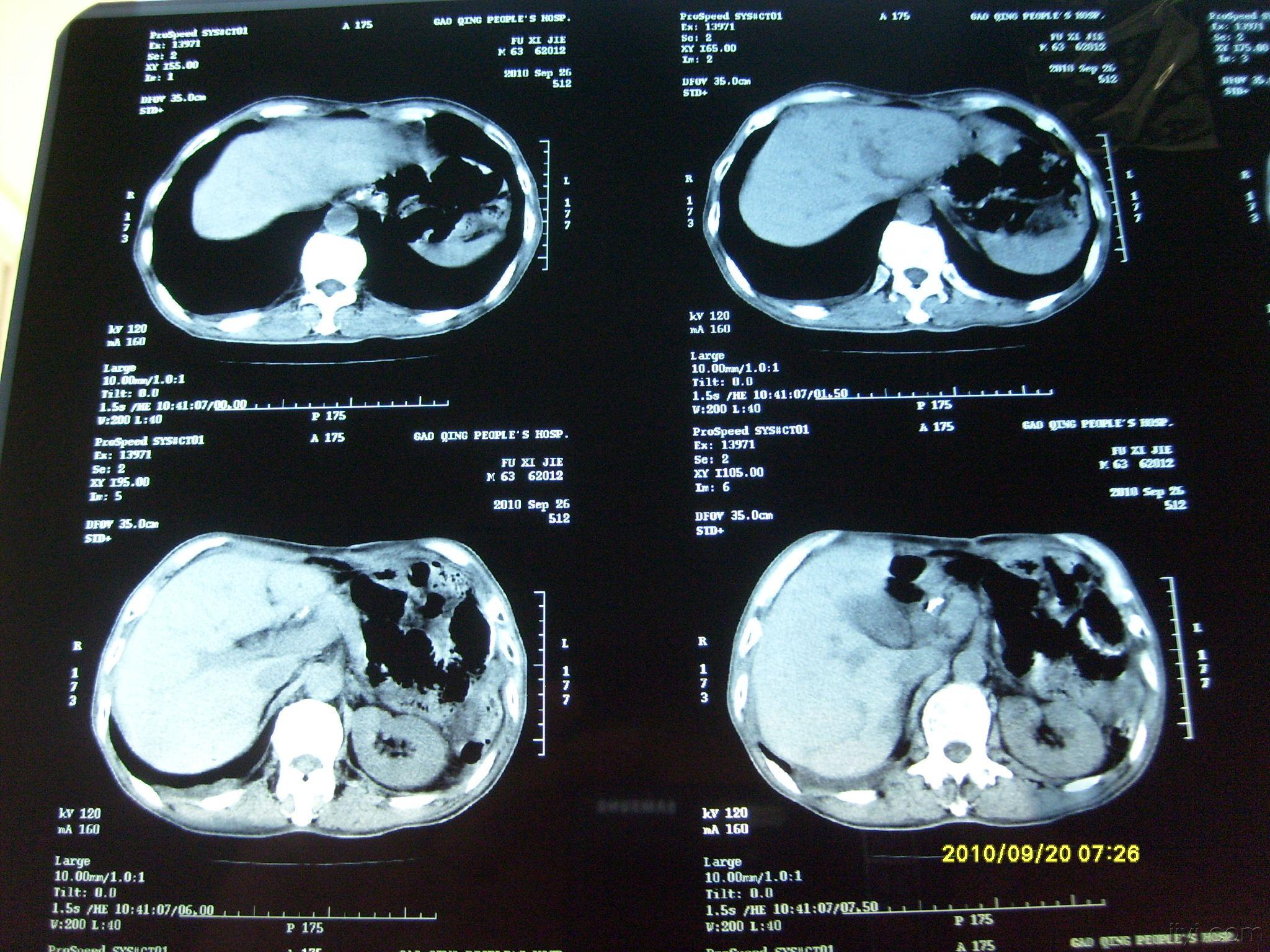 腹部ct,胃癌术后3个月,请帮忙分析
