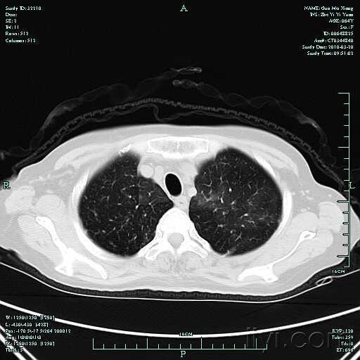 014号《有奖比赛》弥漫性泛细支气管炎典型肺部ct