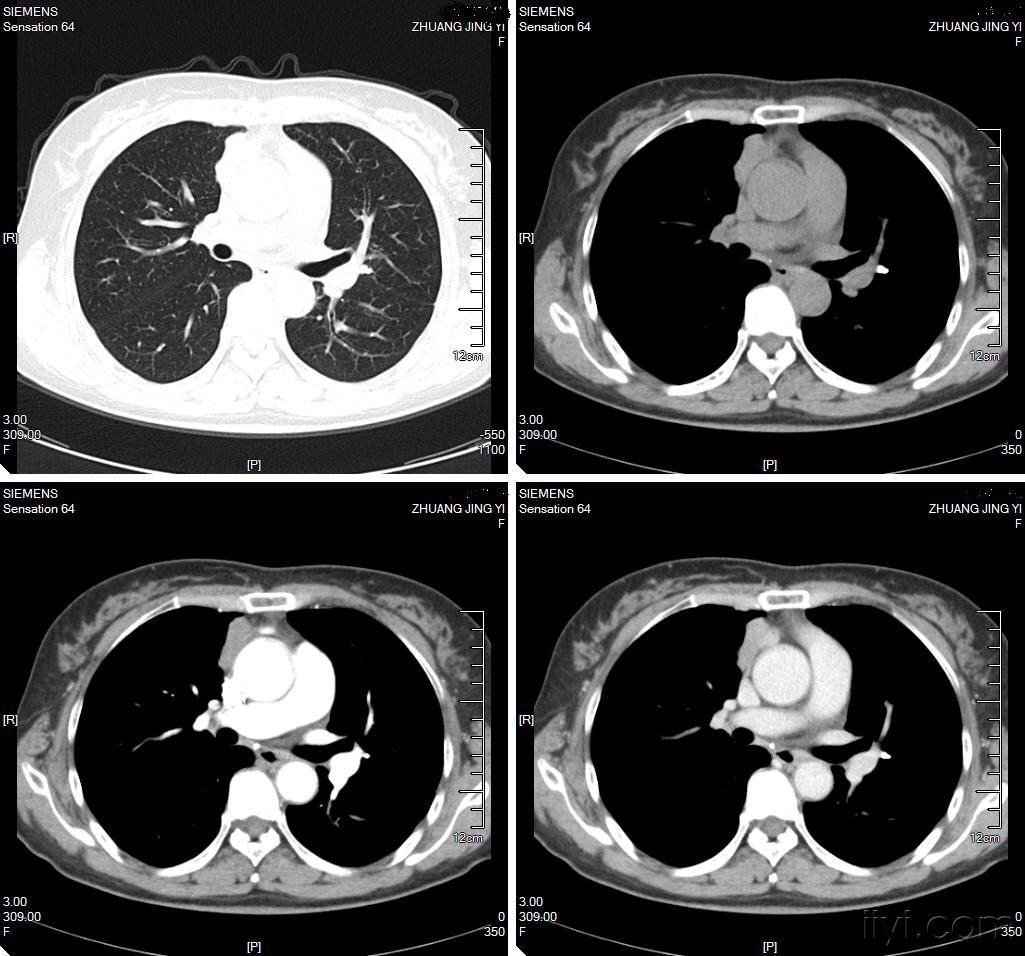 胸部ct 平扫 增强 病理四天后公布