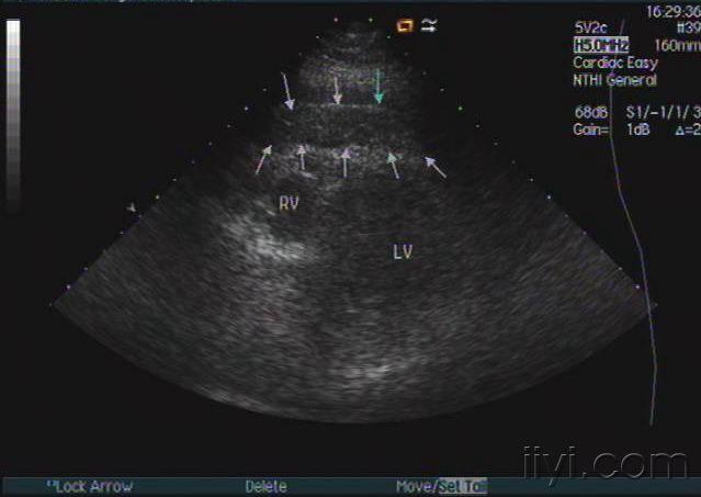 请问各位超声诊断过心包脂肪垫没有zengerya