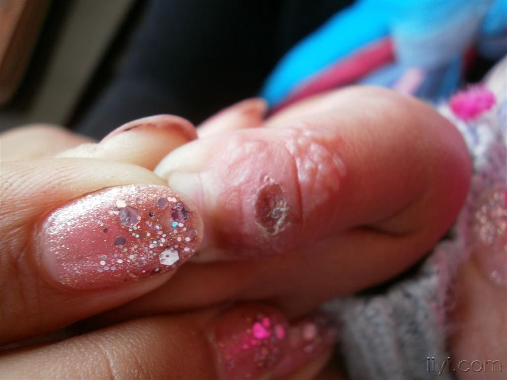 婴儿手指单纯疱疹