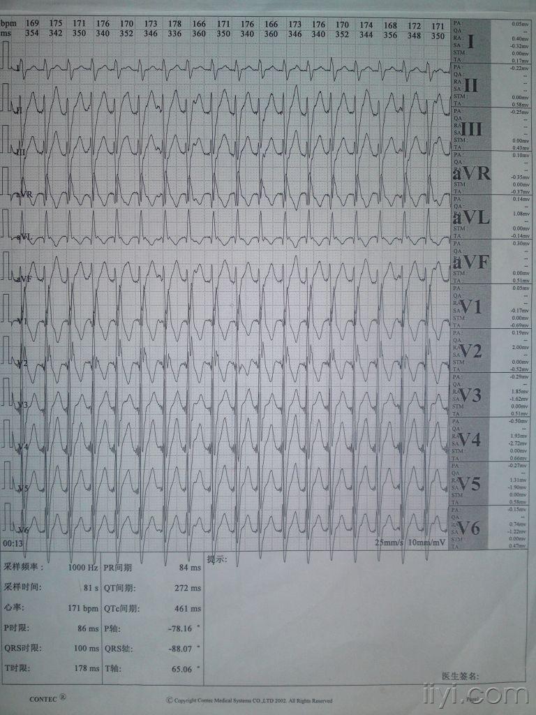 [心电图分析] 室上速?室速?