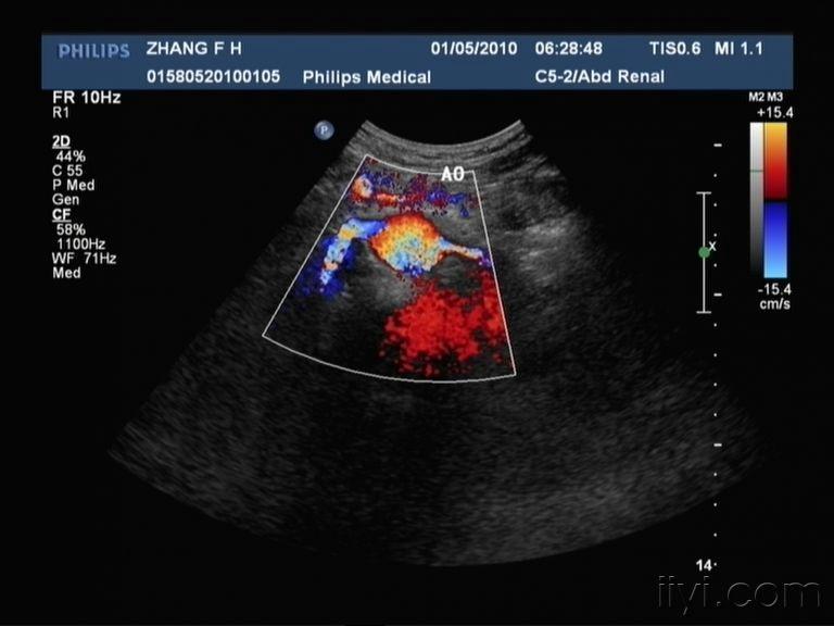 肾动脉狭窄图 - 超声医学讨论版 - 爱爱医医学论坛