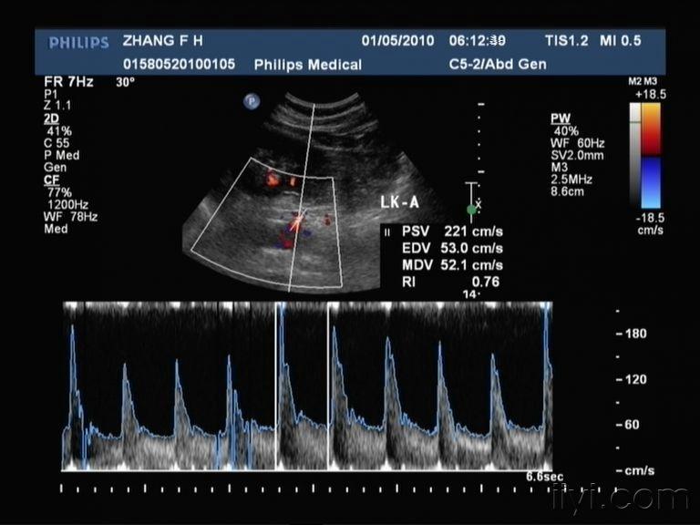 肾动脉狭窄图 - 超声医学讨论版 - 爱爱医医学论坛