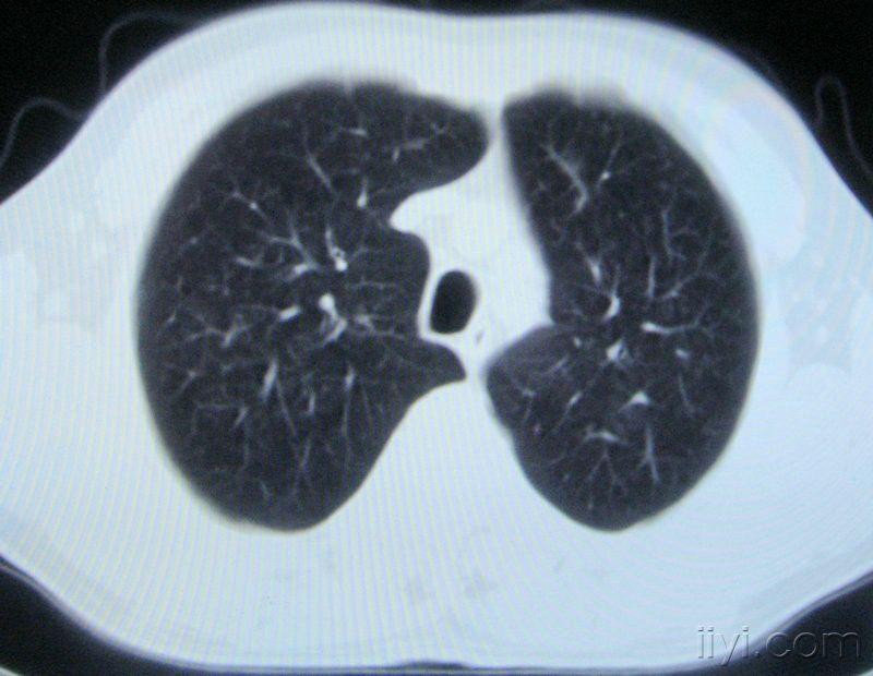 60岁,胸片示支气管炎治疗后复查ct.