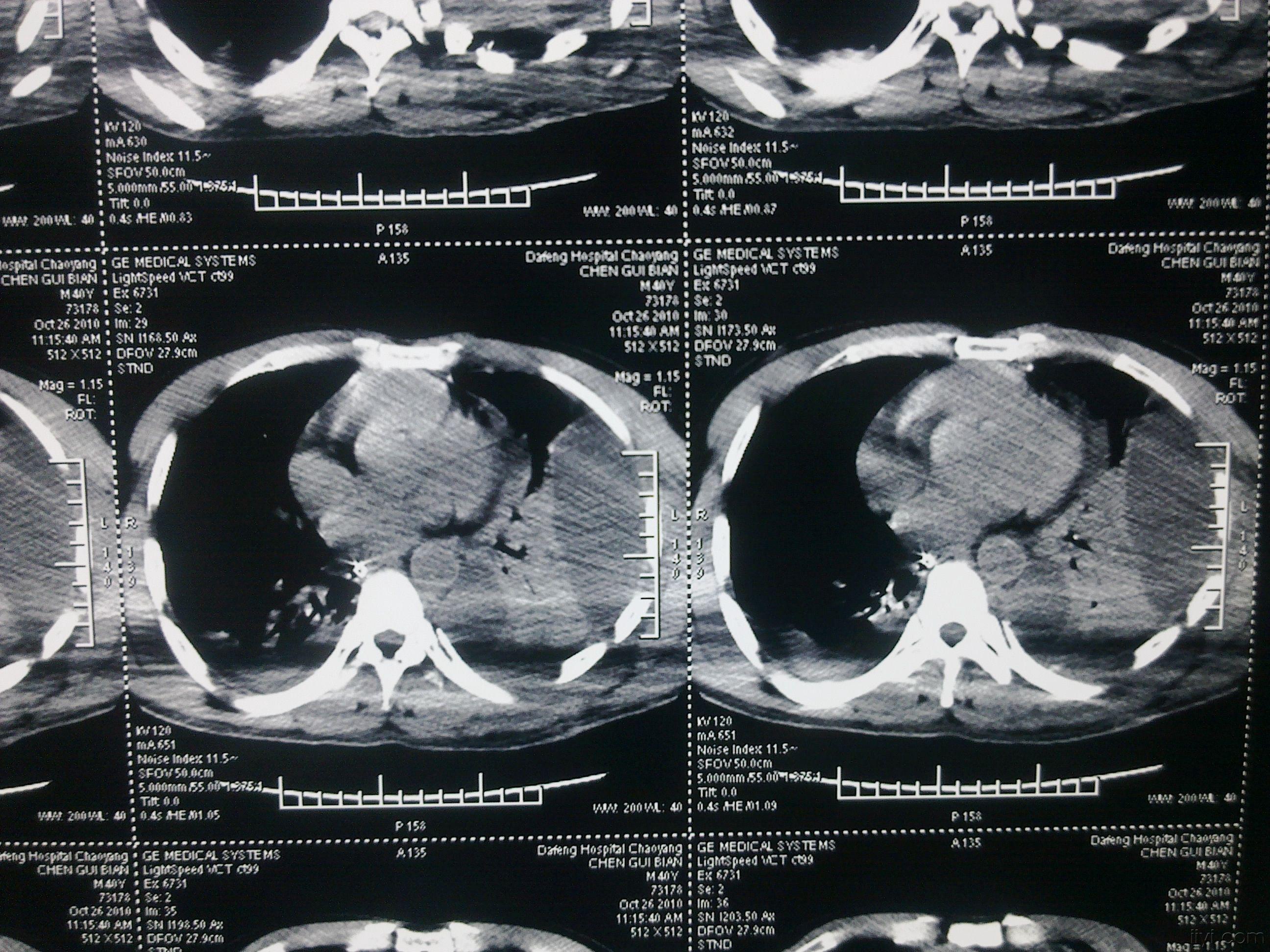多发性肋骨骨折创伤性湿肺术后肺积血治疗讨论(付经典肋骨重建图片)