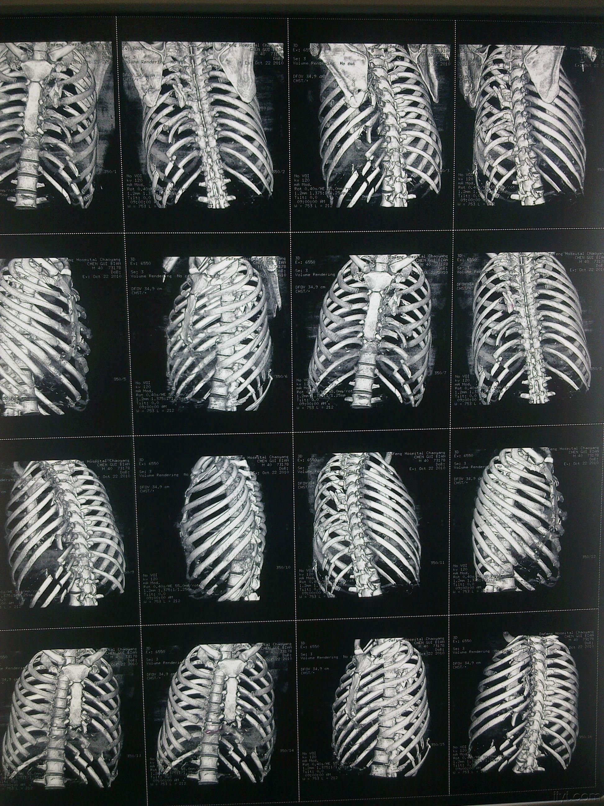 多发性肋骨骨折创伤性湿肺术后肺积血治疗讨论付经典肋骨重建图片