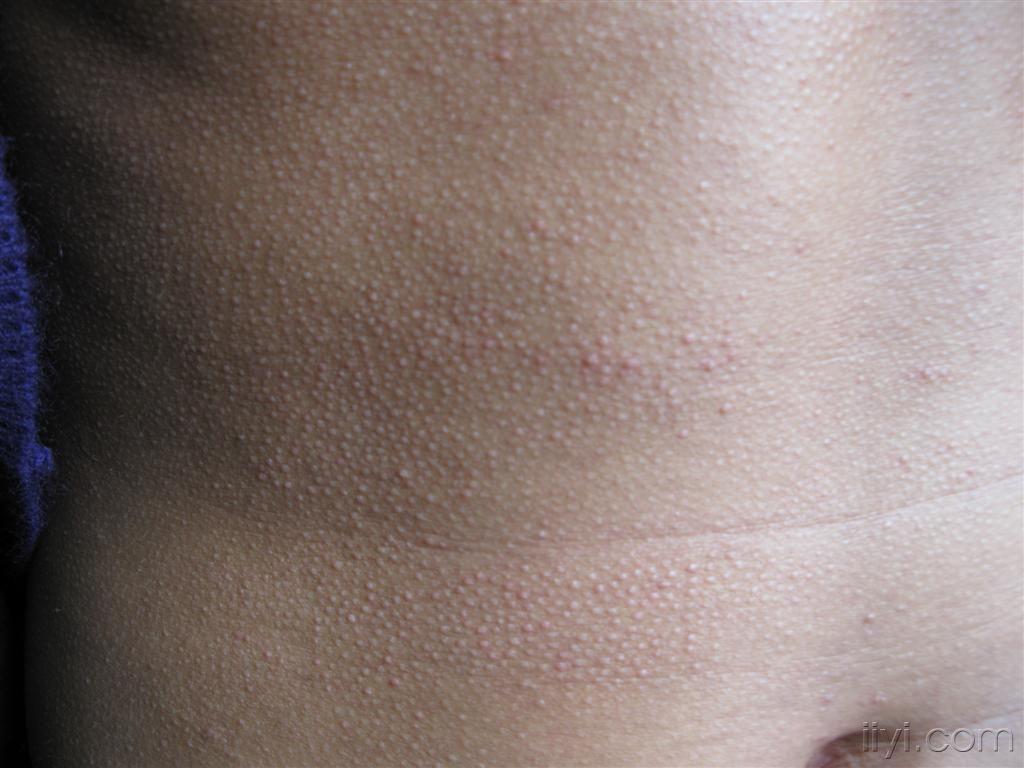 胸前背后泛发的毛囊性红色米粒大丘疹,呈鸡皮状,无明显自觉症状.