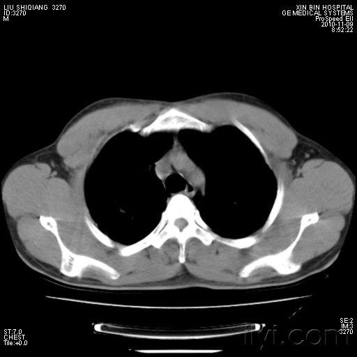 一个貌似矽肺的ct平扫 医学影像学讨论版 爱爱医医学论坛