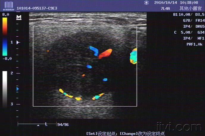 典型腮腺多形性腺瘤一例 超声医学讨论版 爱爱医医学论坛