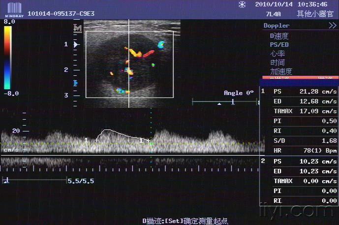 典型腮腺多形性腺瘤一例 超声医学讨论版 爱爱医医学论坛