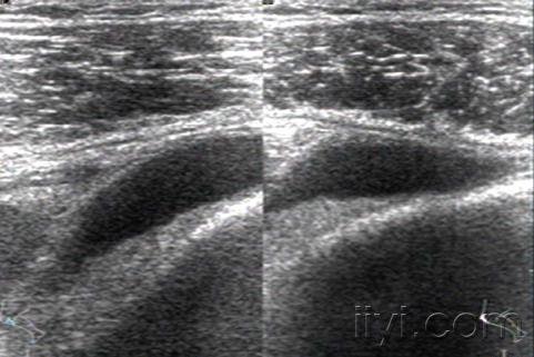 髌上囊积液,治疗前后对比. - 超声医学讨论版 - 爱爱