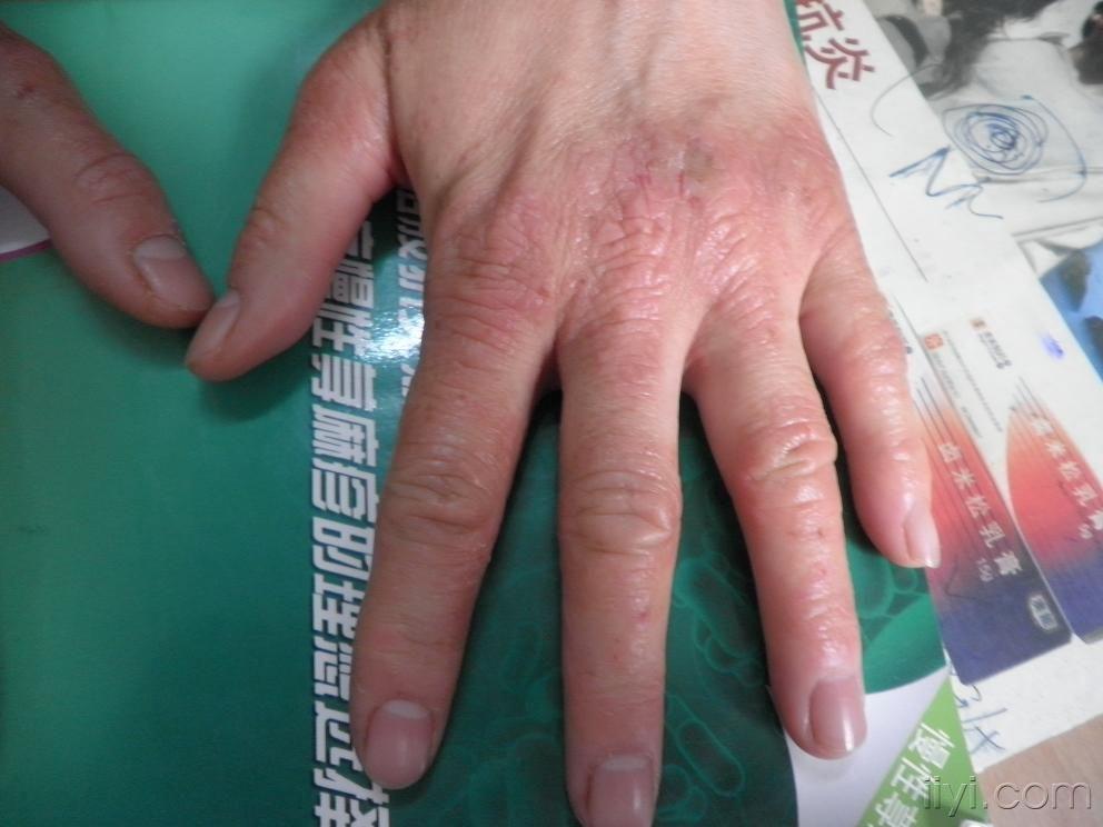 系列皮肤病手部湿疹及治疗效果