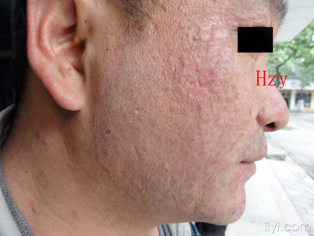脸部皮损在其它医院诊断为皮炎越治越重已半年